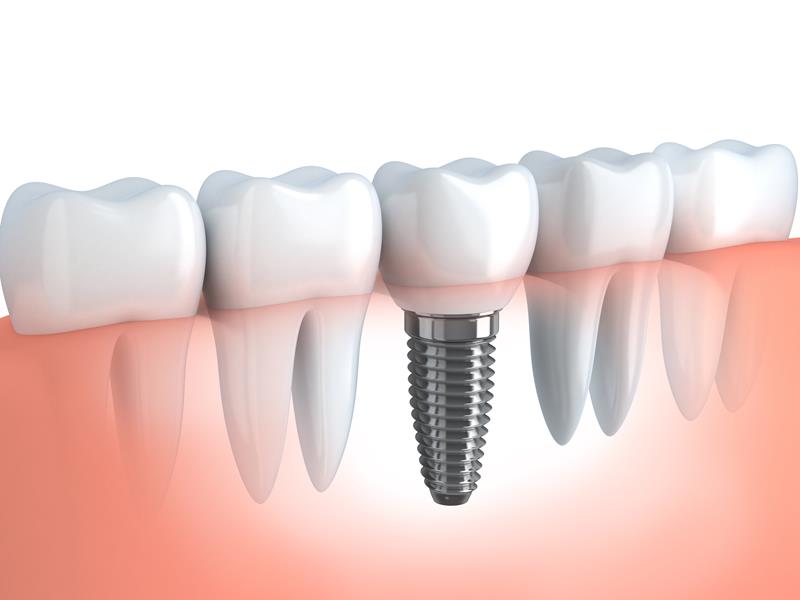 Dental Implants Houston, TX 